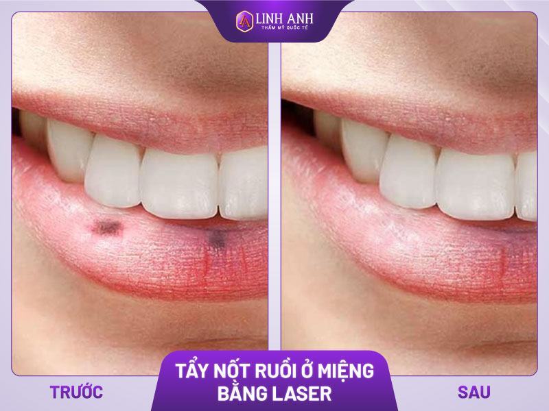 nốt ruồi ở mồm