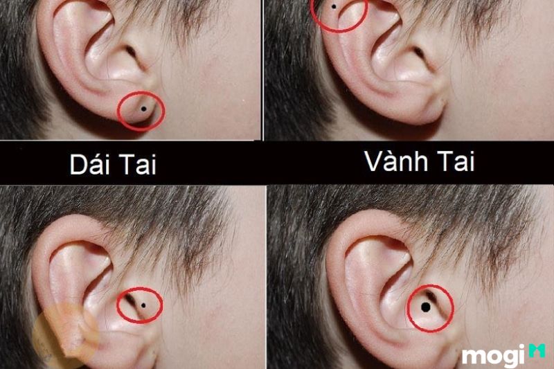 Ý nghĩa nốt ruồi ở tai của nam giới