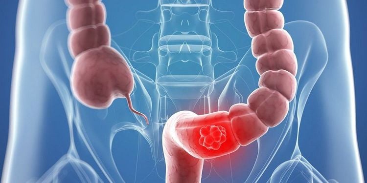 Đa số polyp đại tràng là lành tính nhưng vẫn có một số khả năng trở thành ác tính