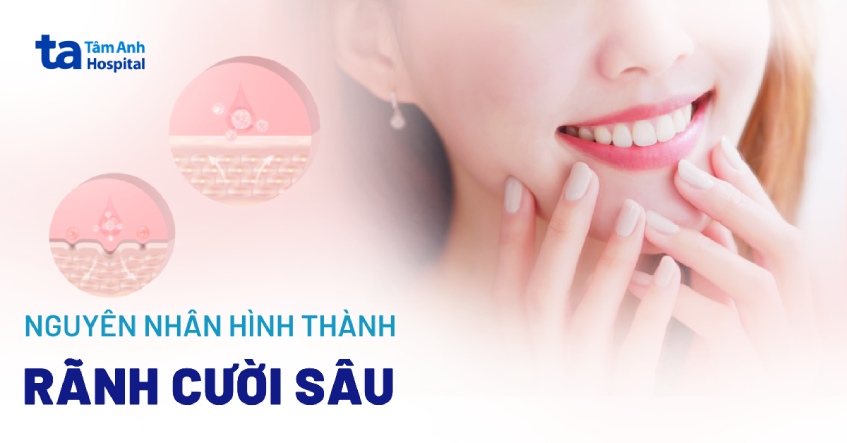 rãnh cười sâu