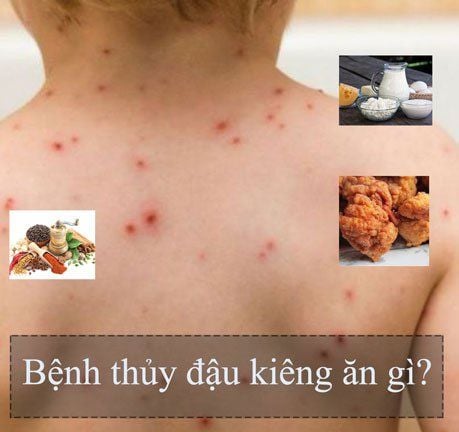 Bị thủy đậu kiêng ăn gì để không bị sẹo?