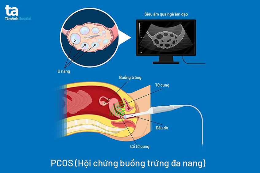 siêu âm buồng trứng