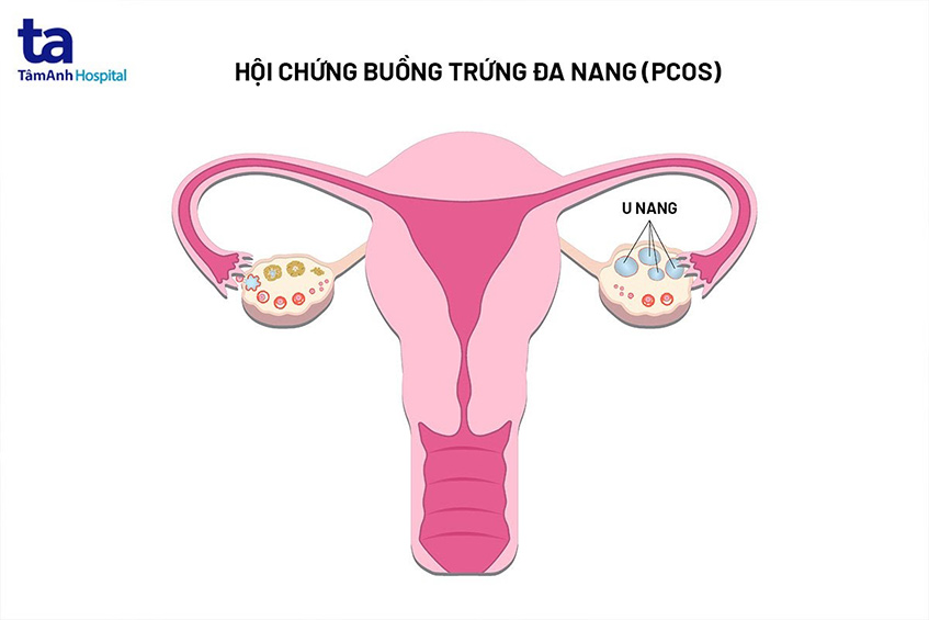 hội chứng buồng trứng đa nang