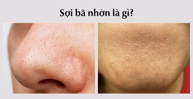 Sợi bã nhờn là gì?