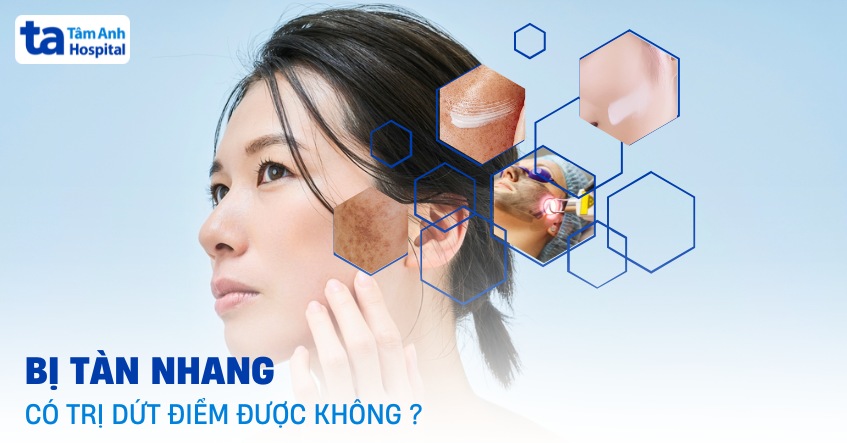 tàn nhang có trị được không