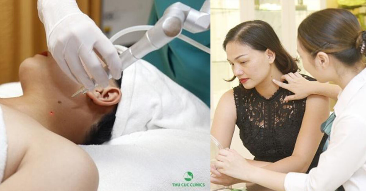 Tẩy nốt ruồi tại phòng khám Doctor Laser