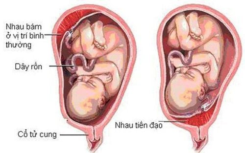 Rau tiền đạo là một trong những nguyên nhân phổ biến gây chảy máu khi mang thai 3 tháng cuối