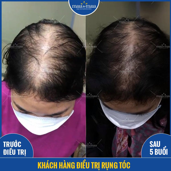 khách hàng trị rụng tóc