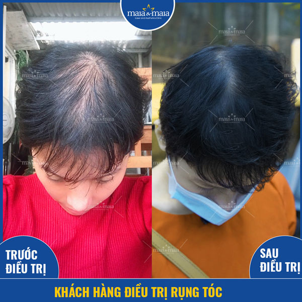 kết quả trị rụng tóc