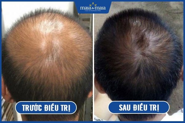 trước sau trị rụng tóc