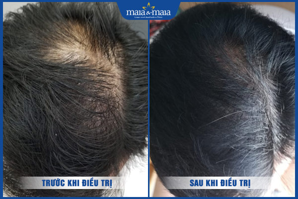 kết quả trị tóc rụng maia