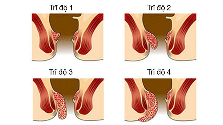 Các mức độ của bệnh trĩ