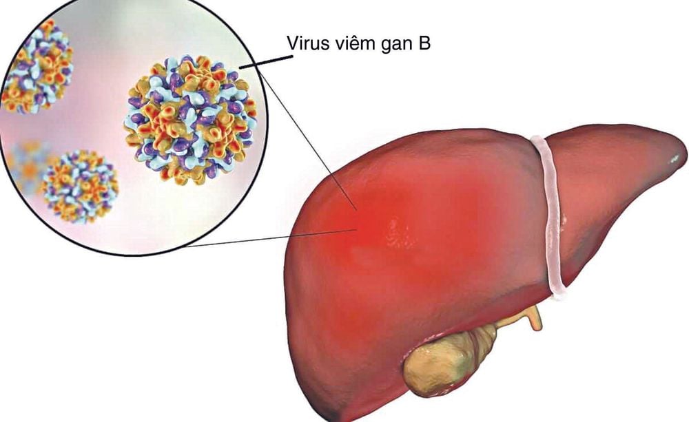 Bệnh viêm gan B do virus mãn tính