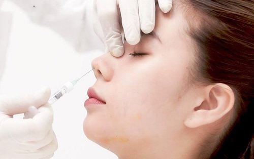 Nâng mũi bằng tiêm filler