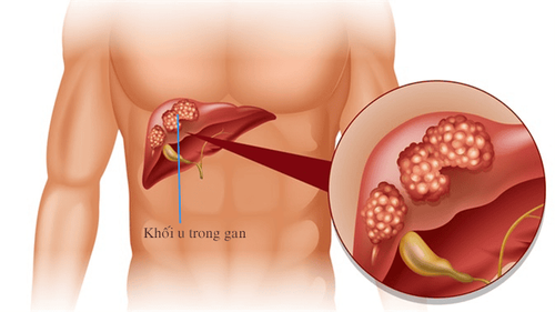 Ung thư thường được gọi tên theo cơ quan mà nó phát sinh như: ung thư gan