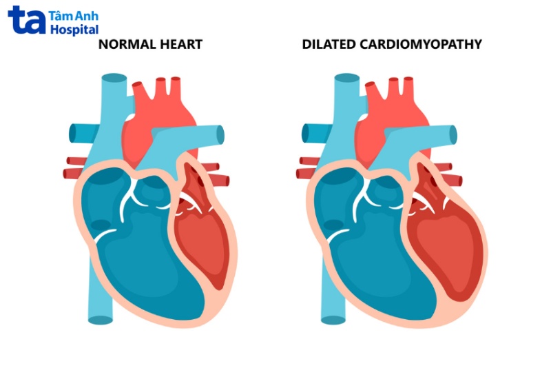 Hình ảnh trái tim khỏe mạnh và bị bệnh cơ tim giãn nở