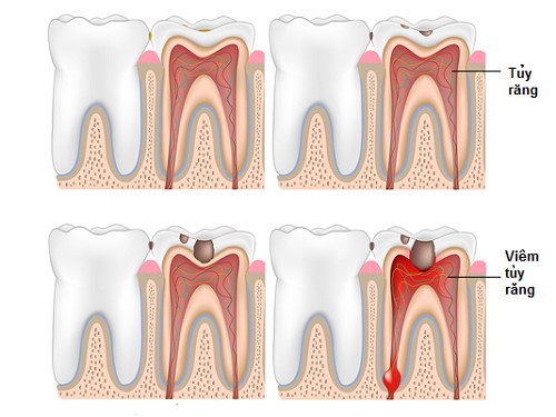 tủy răng khỏe mạnh và tủy răng bị viêm