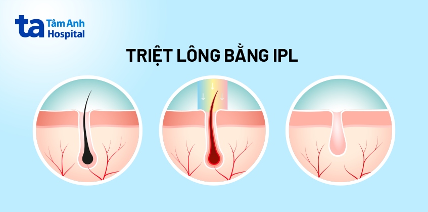 sử dụng công nghệ ipl để triệt lông