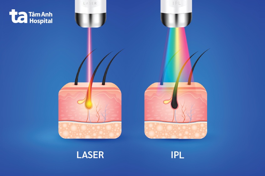 phương pháp triệt lông nách vĩnh viễn hiệu quả