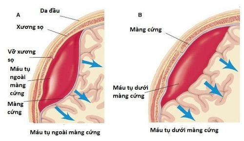 Máu tụ dưới màng cứng được phân ra làm 3 loại