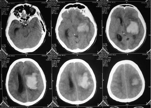 Hình ảnh CT Scan trên bệnh nhân bị tụ máu do chấn thương sọ não