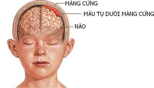 Tụ máu não xảy ra khi có một mạch máu bên trong não hoặc nằm giữa não và hộp sọ bị vỡ, tích tụ máu gây chèn ép các mô não