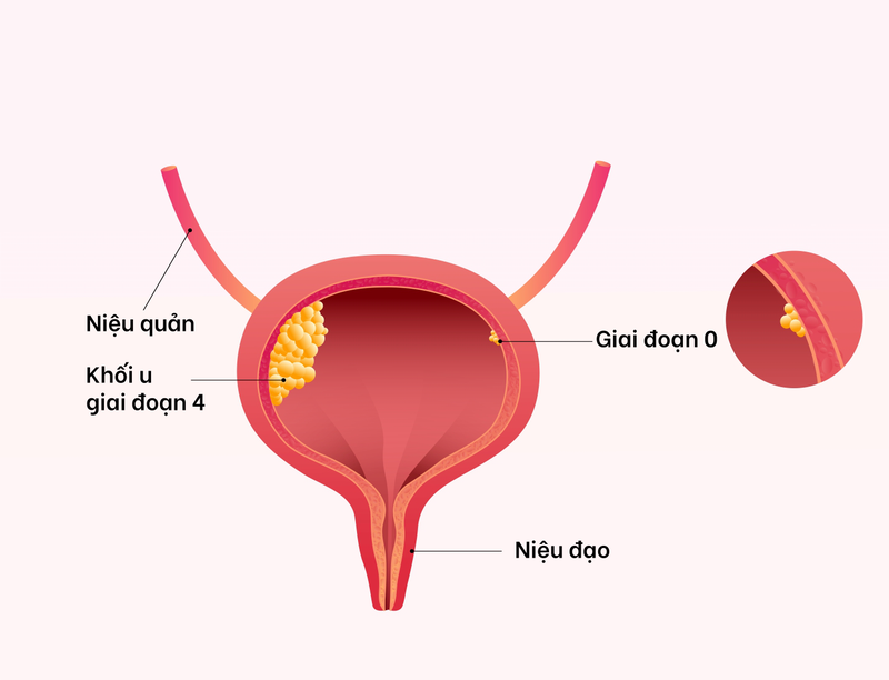 Khoa ung bướu là gì và chức năng của khoa ung bướu? 2