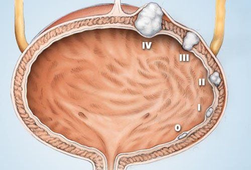 Các giai đoạn phát triển của ung thư bàng quang