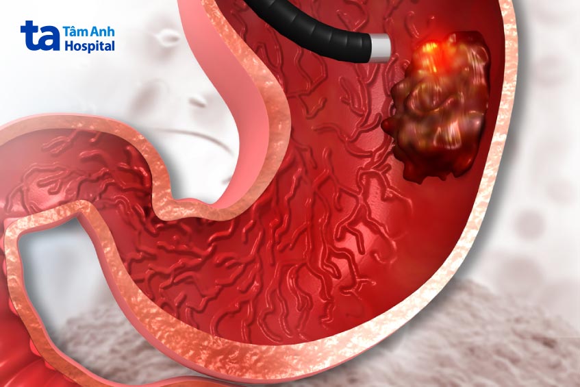 ung thư dạ dày thường không có triệu chứng nên khó phát hiện