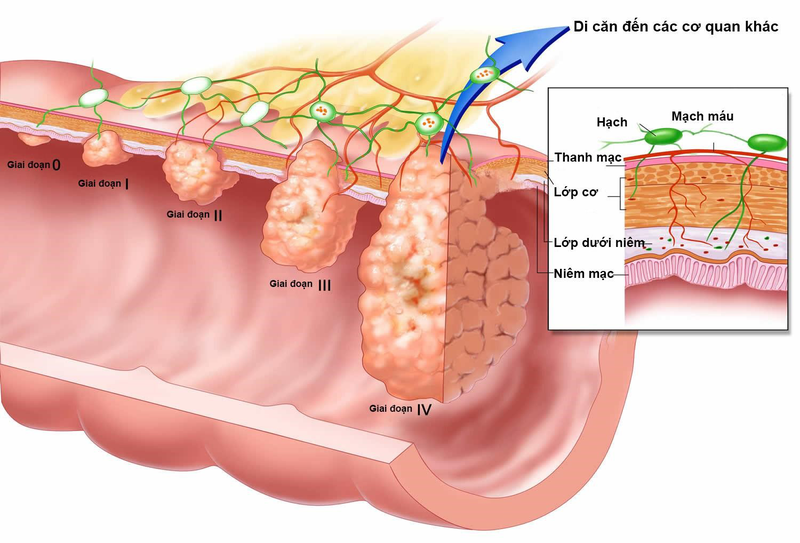 Ung thư thực quản giai đoạn cuối: Triệu chứng, hướng điều trị và tiên lượng 1