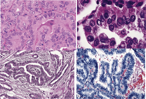 Hình ảnh carcinôm tuyến giáp dạng nhú (vi thể)