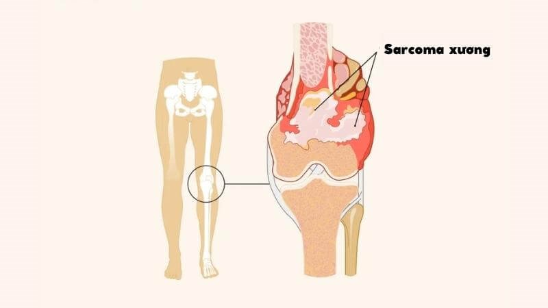 Ung thư xương là gì? Nguyên nhân, dấu hiệu, biến chứng và điều trị