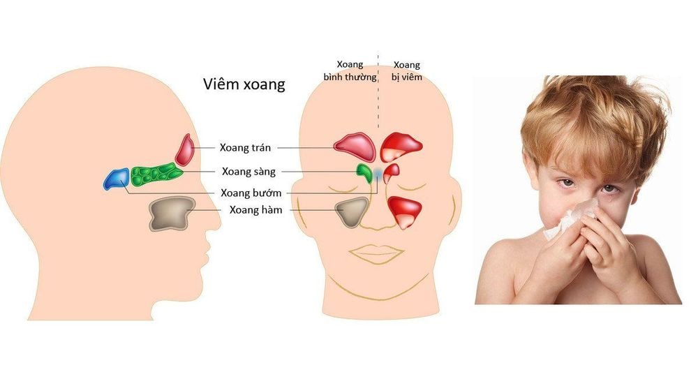 Trẻ bị viêm xoang tăng nguy cơ nhiễm trùng tai