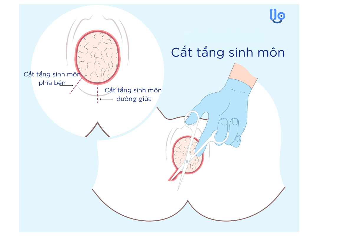 Dấu hiệu vết khâu tầng sinh môn đang lành