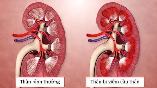 Viêm cầu thận là một trong các biến chứng của viêm gan B mạn tính