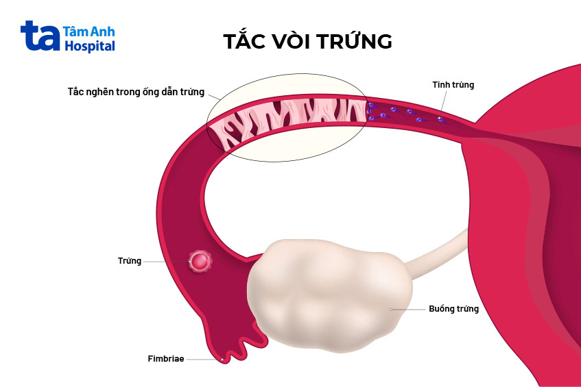 Vòi trứng bị ứ tắc gây cản trở đường đi của tinh trùng