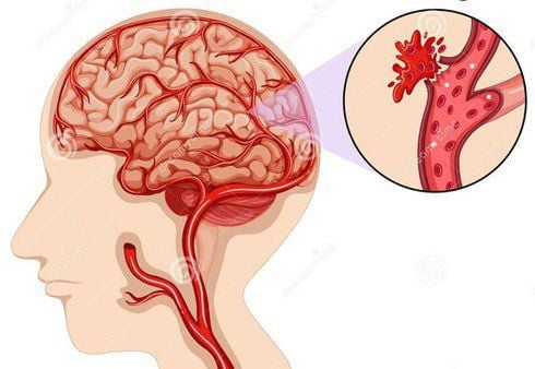 Xuất huyết não tự phát có tỉ lệ tử vong cao nhất trong tất cả tai biến mạch máu não