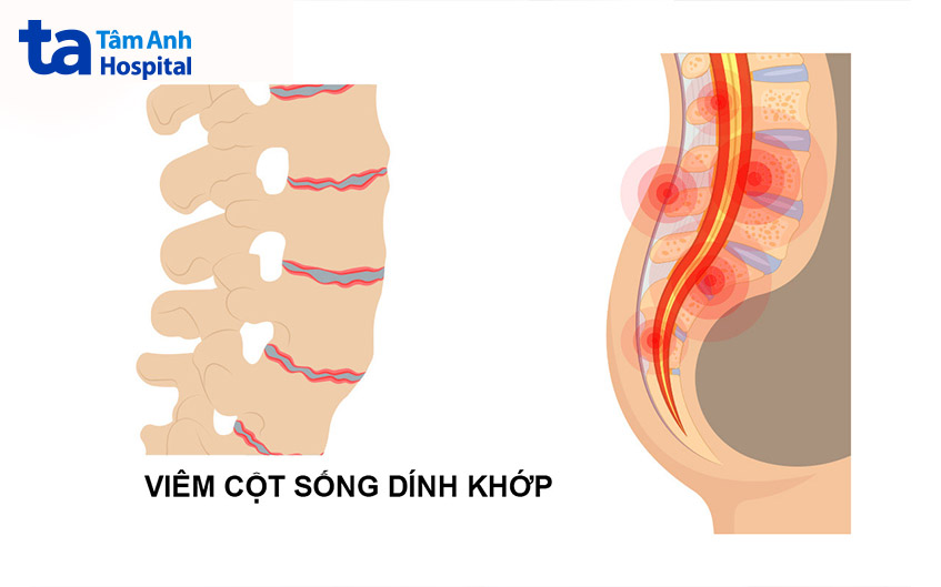 tình trạng viêm cột sống dính khớp