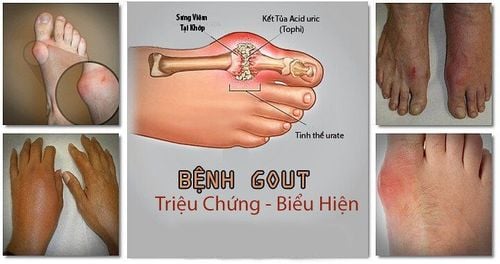 Triệu chứng gout thường xuất hiện ở khớp đơn lẻ.