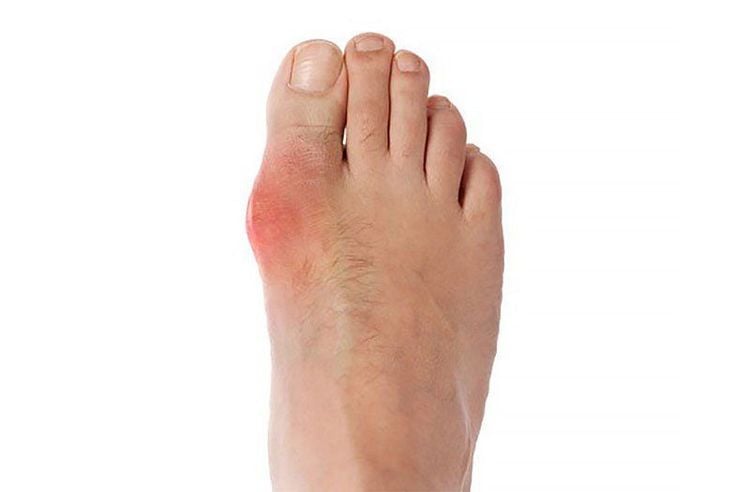 Triệu chứng gout thường gây đau và sưng ở giai đoạn đầu