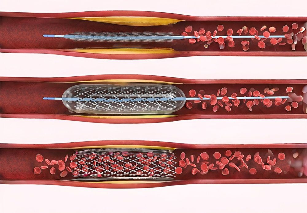 Phương pháp đặt stent mạch vành