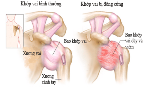 Viêm đông khớp vai