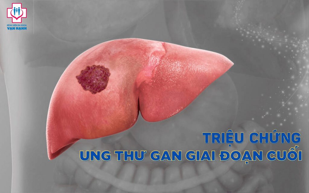 triệu chứng ung thư gan giai đoạn cuối