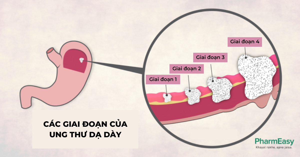 Các giai đoạn của ung thư dạ dày