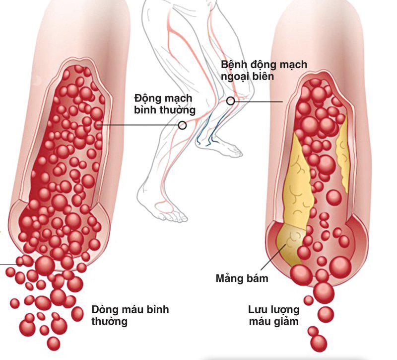 7 bệnh tim mạch thường gặp và các triệu chứng