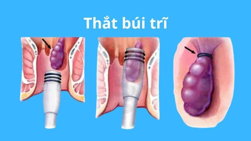 Thắt bũi trĩ là một phương pháp dùng để điều trị trĩ