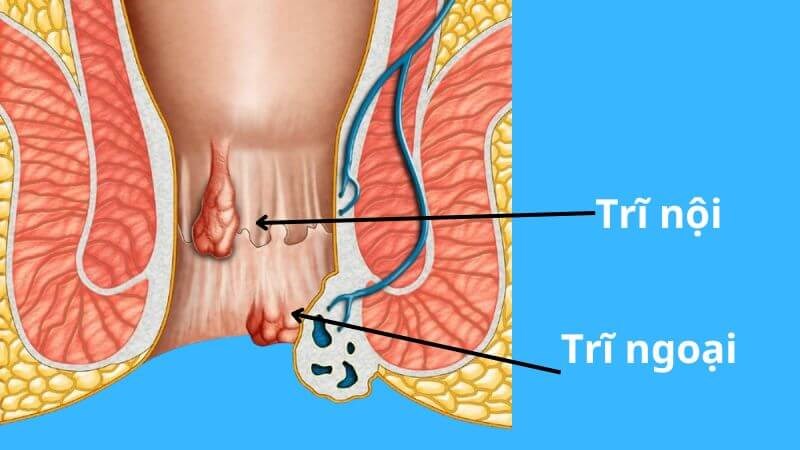 Trĩ được chia thành hai loại