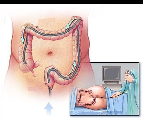 Phương pháp nội soi được sử dụng trong việc cắt polyp trực tràng