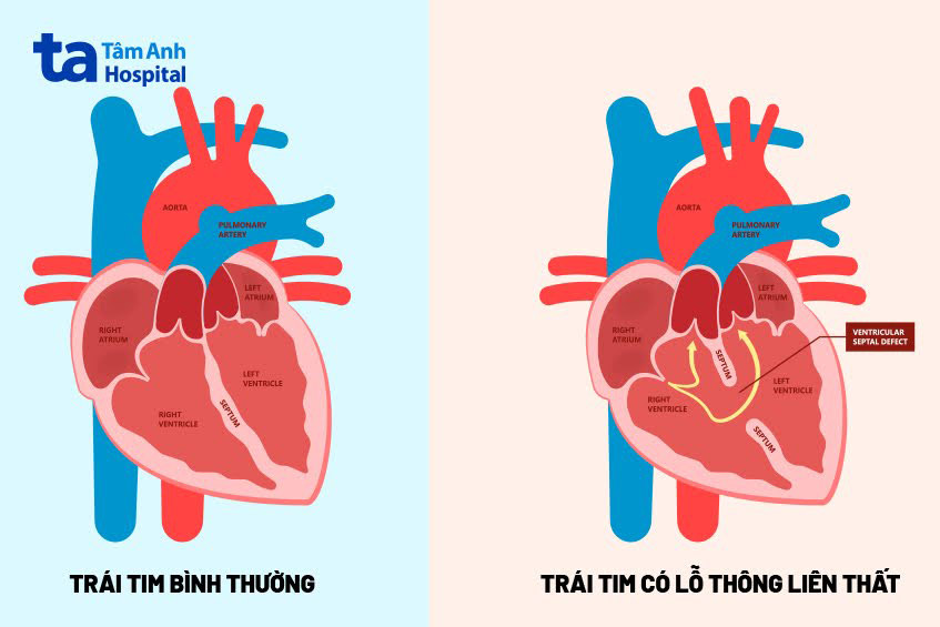 Chi phí mổ tim thông liên thất còn tùy thuộc vào tình trạng của mỗi bệnh nhân