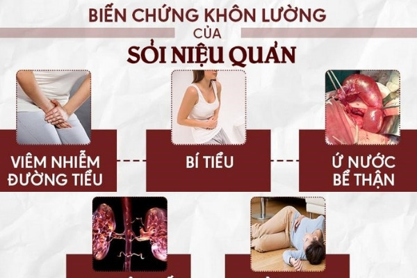 Sỏi niệu quản thường gây ra những biến chứng không ngờ ảnh hưởng sức khỏe người bệnh